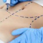 Cirurgia reparadora pós-bariátrica negada: como agir contra plano de saúde ou SUS e pedir urgência